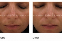 pca peel b&a