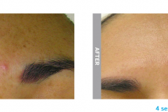 Hydrafacial hyperpigmentation b&a