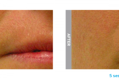 Hydrafacial nasolabial b&a