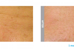 Hydrafacial wrinkles b&a 2