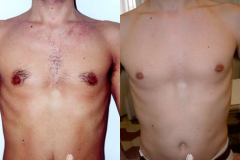 LHR_chest b&a