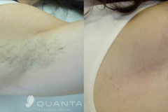 LHR_underarm b&a