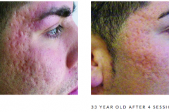 Microneedling scarring 2 b&a