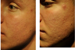 Microneedling scarring b&a