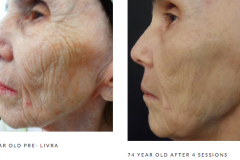 Microneedling wrinkles 2 b&a