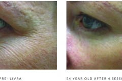 Microneedling wrinkles b&a