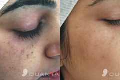 Laser pigmented lesions b&a