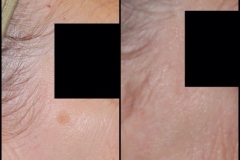 laser pigmented lesion 2 b&a