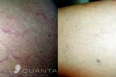 Laser spider veins b&a 2